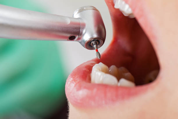 Best Emergency Wisdom Teeth Removal in Port Allegany, PA